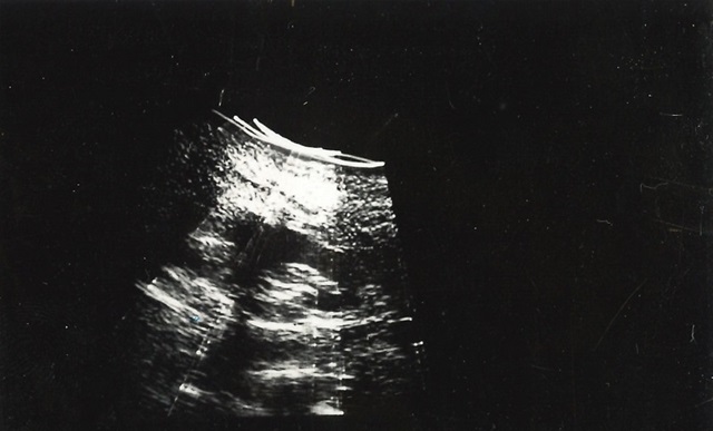 Ultrasound